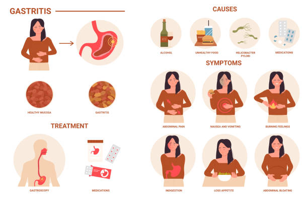 gastritis medical infographics, disease of digestive tract, causes symptoms treatment - 病徵 插圖 幅插畫檔、美工圖案、卡通及圖標
