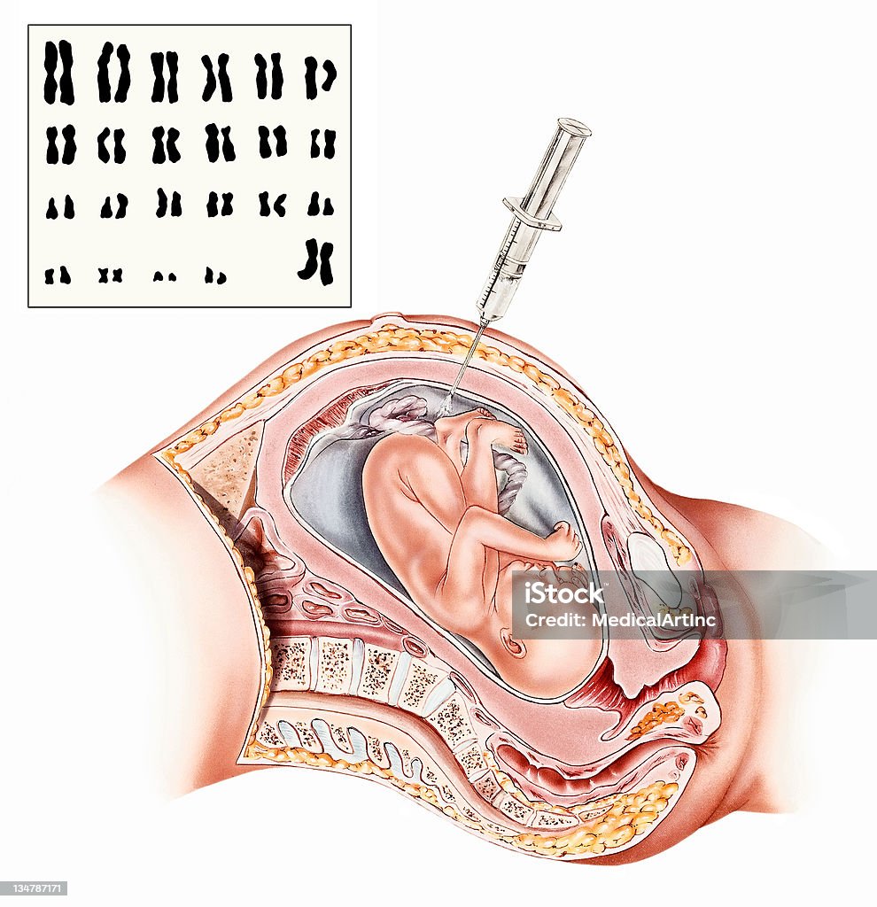 Embarazo, Amniocentesis - Ilustración de stock de Amniocentesis libre de derechos