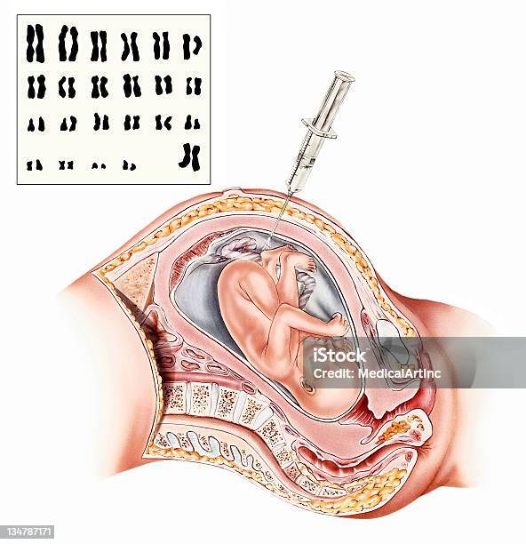 Ilustración de Embarazo Amniocentesis y más Vectores Libres de Derechos de Amniocentesis - Amniocentesis, Feto - Etapa humana, Ilustración