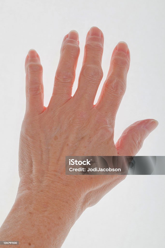 hand with arthritis female senior citizen hand with arthritis Scleroderma - Illness Stock Photo