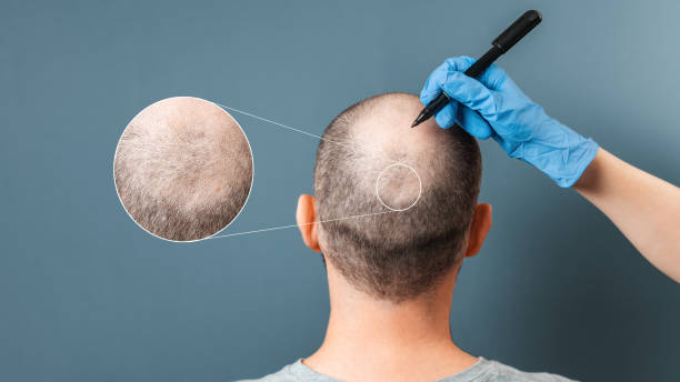 Hair Growth Treatment