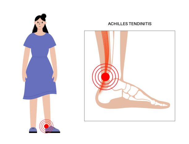 Achilles tendon injury Achilles tendinitis anatomical poster. Ankle injury, ligament sprain and tear problems. Pain in the human muscular system. Tendinosis and podiatry, trauma in foot joints flat vector illustration. x ray tarsal ankle and foot stock illustrations