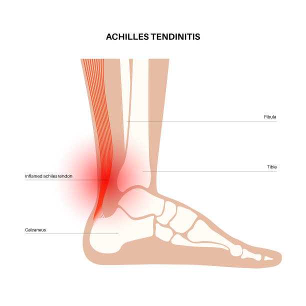 Achilles tendon injury Achilles tendinitis anatomical poster. Ankle injury, ligament sprain and tear problems. Pain in the human muscular system. Tendinosis and podiatry, trauma in foot joints flat vector illustration. x ray tarsal ankle and foot stock illustrations