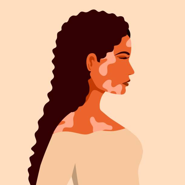 vitiligo ist eine junge frau mit hautproblemen. hautkrankheiten. das konzept des welt-vitiligo-tages. verschiedene hautfarben weiblicher charaktere. für einen blog, artikel, banner, magazin. - skin singer stock-grafiken, -clipart, -cartoons und -symbole