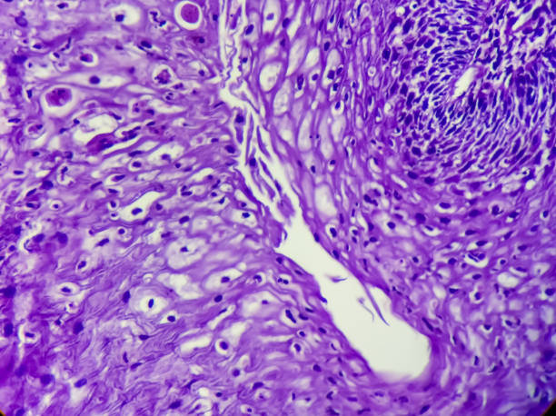 Cancer of Esophagus, Invasive squamous cell carcinoma, grade-II, The tumor is moderately differentiated,100x view Cancer of Esophagus, Invasive squamous cell carcinoma, grade-II, The tumor is moderately differentiated,100x view squamous cell carcinoma photos stock pictures, royalty-free photos & images