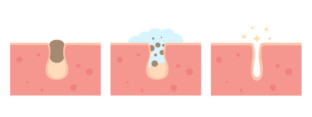cleaning clogged pores process - delik illüstrasyonlar stock illustrations