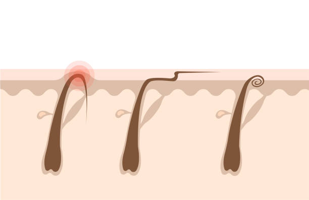 ilustrações de stock, clip art, desenhos animados e ícones de types of ingrown hairs - waxing