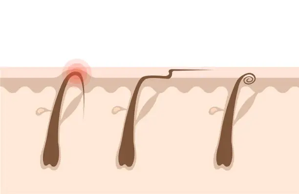 Vector illustration of Types of ingrown hairs