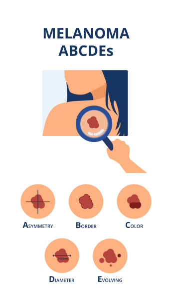 Melanoma ABCDEs symptoms Melanoma ABCDEs symptoms like big diameter, asymmetry, uneven color, uneven border and evolving next to hand of doctor detecting skin cancer spot on back of patient skin cancer stock illustrations