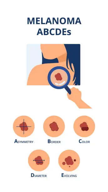 Vector illustration of Melanoma ABCDEs symptoms