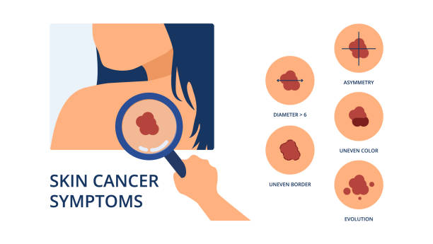 Skin cancer symptoms Skin cancer symptoms like big diameter, asymmetry, uneven color, uneven border and evolution next to hand of doctor detecting melanoma spot on skin of woman doctor borders stock illustrations
