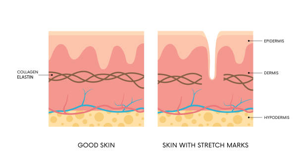 Anatomy of skin with and without stretch mark Anatomy of skin with and without stretch marks. Collagen, elastin, striae. Body positivity, beauty, skincare concepts tissue anatomy stock illustrations