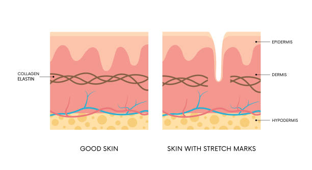 Anatomy of skin with and without stretch mark Anatomy of skin with and without stretch marks. Collagen, elastin, striae. Body positivity, beauty, skincare concepts scar stock illustrations