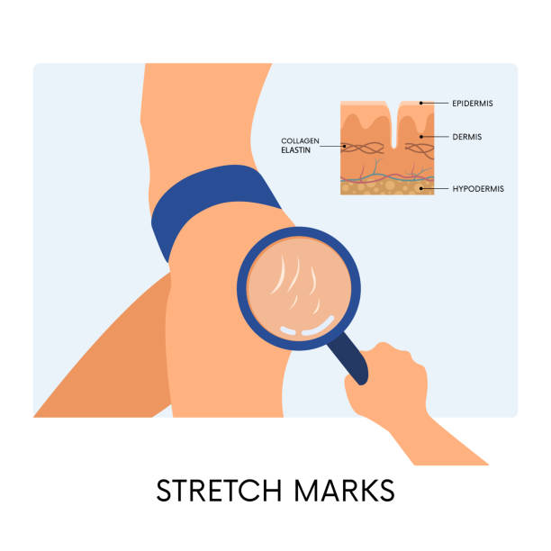 Female body with stretchmarks on hips Female body with stretchmarks on hips and hand with magnifying glass and skin anatomy illustration. Striae on woman hips. Body positivity, beauty, skincare concepts Stretch Mark Cream stock illustrations
