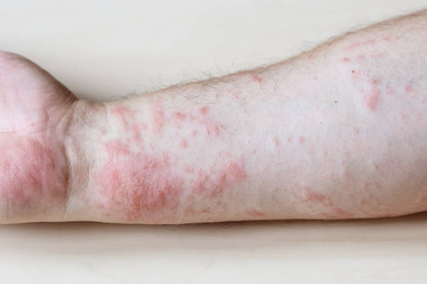 istock itchy rash on side of forearm close up 1348076717