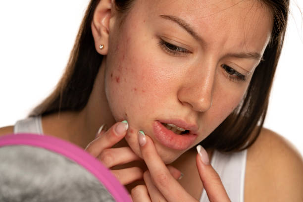 istock a young beautiful woman squeezes pimples on her cheek 1348094430