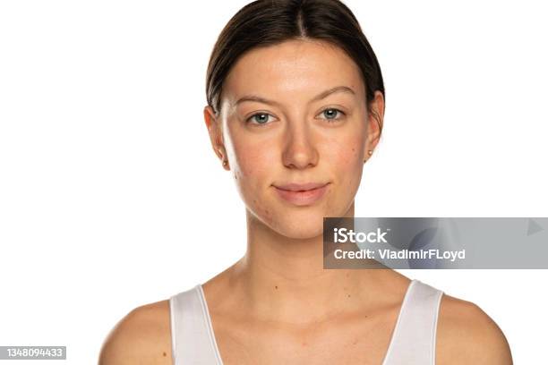 Schöne Lächelnde Frau Ohne Makeup Und Problematische Haut Stockfoto und ...