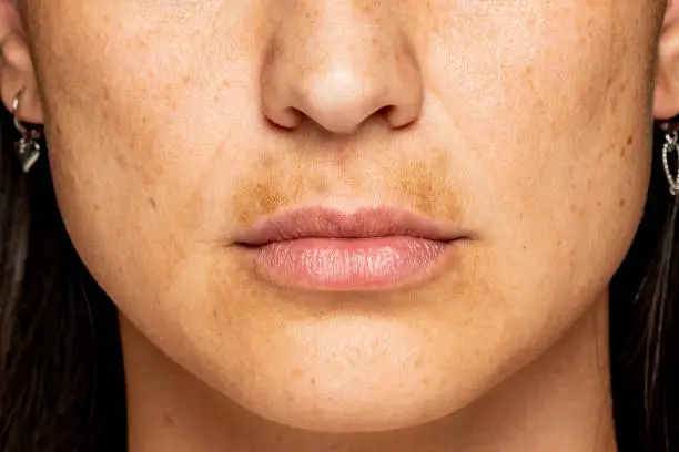 Photo of dark skin on the upper lip