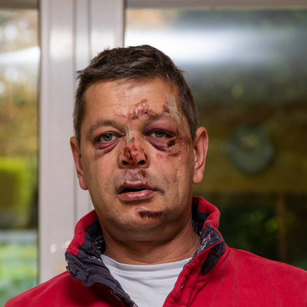 retrato de un hombre que está herido en la cara. - cardenal lesión física fotografías e imágenes de stock