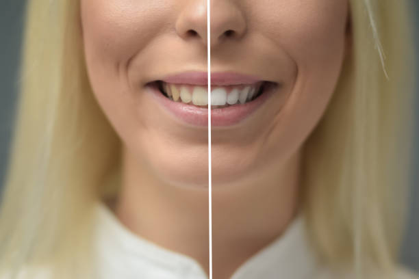 istock Before and after of teeth whitening 1348693689