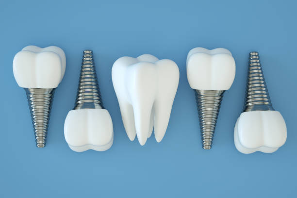 impianto dentale, denti artificiali, impianto dentale, sfondo blu - impianto dentale foto e immagini stock