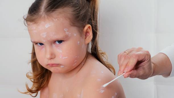 trauriges kleines mädchen mit windpocken, antiseptische creme auf den hautausschlag aufgetragen. hautausschlag. der resultierende ausschlag sieht aus wie rosa flecken, die sich in papeln verwandeln, von denen einige. bei hautausschlägen tritt ein enanthe - chickenpox skin condition baby illness stock-fotos und bilder