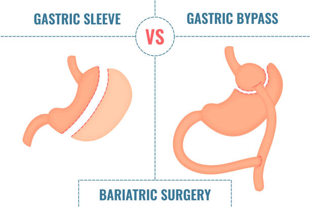 magenhülse vs magenbypass bariatrische chirurgie gewichtsverlust infografiken - endoskop stock-grafiken, -clipart, -cartoons und -symbole