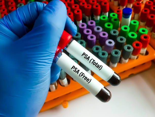 Technician hold blood samples for PSA (Total) and PSA (Free) test. Prostate specific antigent, diagnosis of prostate cancer stock photo