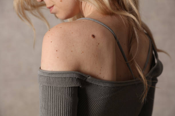 Checking benign moles : Portrait of Beautiful Woman with birthmarks on her back and face. Laser skin tags removal stock photo