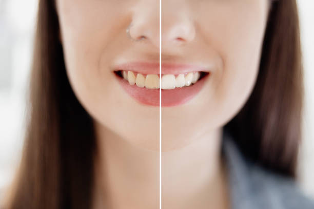 dientes de mujer antes y después del blanqueamiento - blanqueamiento dental fotografías e imágenes de stock