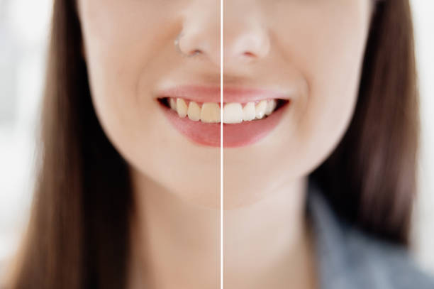 Woman teeth before and after whitening