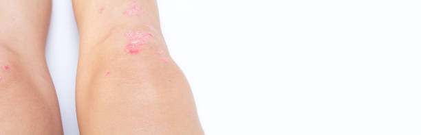 istock Knee joint effusion (water on knee) Acute psoriatic arthritis, osteoarthritis, meniscus tear. Excess synovial fluid in and around the knee joint 1349063082