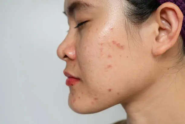 Photo of Close up of Asian woman having acne inflamed on her cheek.