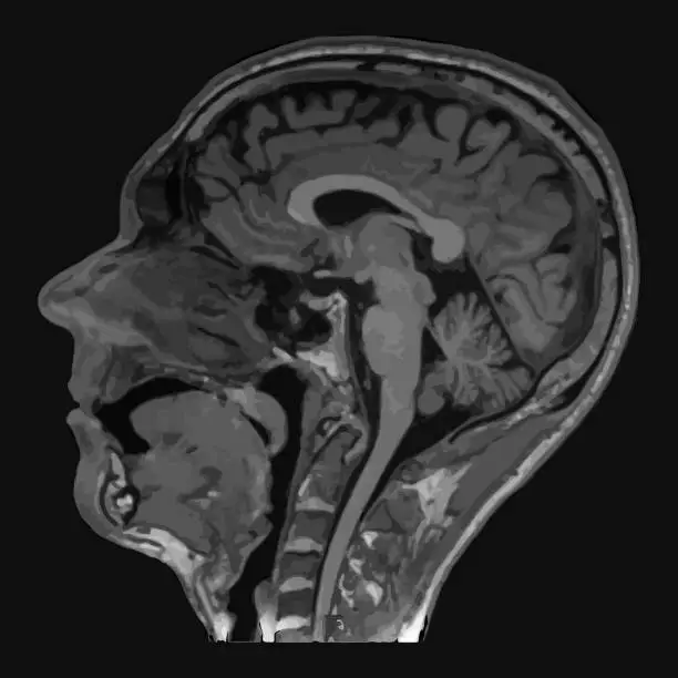 Vector illustration of Realistic image sagittal of male head with CT scan, MRI Magnetic resonance imaging layer of head. Isolated on dark background.