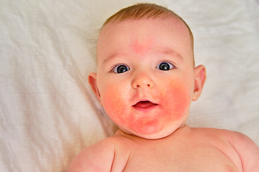 Portrait of a happy infant baby with allergies, red skin dermatitis