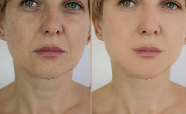 istock woman face wrinkles before and after treatment 1349207377