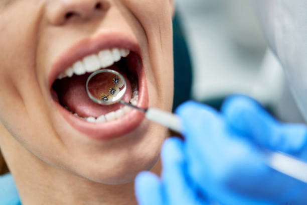 primer plano de la mujer durante el chequeo de aparatos linguales en la clínica dental. - lingual fotografías e imágenes de stock