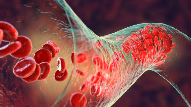 Blood clot made of red blood cells, platelets and fibrin protein strands stock photo