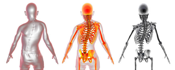척추측만증, 3d 일러스트레이션. 구부러진 척추, 고르지 않은 어깨, 엉덩이가 있는 인체 - human spine chiropractor three dimensional shape healthcare and medicine 뉴스 사진 이미지