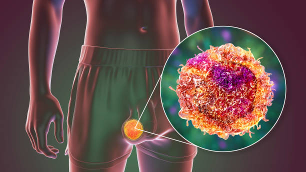 Testicular cancer, 3D illustration Testicular cancer, medical 3D illustration showing malignant tumor in the testis and close-up view of testicular cancer cell testis stock pictures, royalty-free photos & images