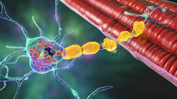 Brain neurons in Tay-Sachs disease, 3D illustration Brain neurons in Tay-Sachs disease, 3D illustration showing swollen neurons with membraneous lamellar inclusions due to accumulation of gangliosides in lysosomes and demyelination medulla stock pictures, royalty-free photos & images