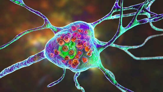 Neuronas cerebrales en la enfermedad de Tay-Sachs, ilustración 3D photo