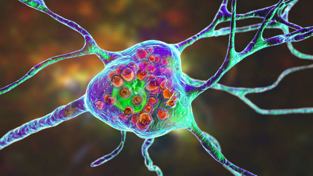 Brain neurons in Tay-Sachs disease, 3D illustration Brain neurons in Tay-Sachs disease, 3D illustration showing swollen neurons with membraneous lamellar inclusions due to accumulation of gangliosides in lysosomes illness stock pictures, royalty-free photos & images