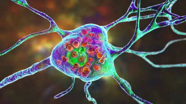 Photo of Brain neurons in Tay-Sachs disease, 3D illustration