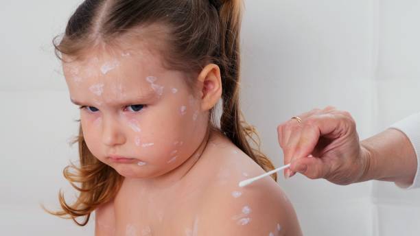 trauriges kleines mädchen mit windpocken, antiseptische creme auf den hautausschlag aufgetragen. hautausschlag. der resultierende ausschlag sieht aus wie rosa flecken, die sich in papeln verwandeln, von denen einige. bei hautausschlägen tritt ein enanthe - chickenpox skin condition baby illness stock-fotos und bilder