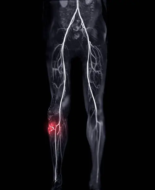 Photo of Magnetic resonance angiography of peripheral runoff vessels showing Arteriovenous malformation.