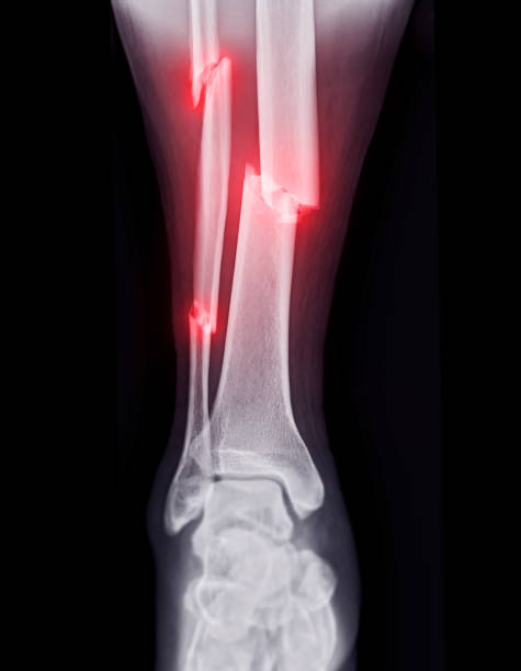 骨折脛骨と脛骨を示す足首関節のx線画像。 - orthopedic equipment osteoporosis x ray human spine ストックフォトと画像