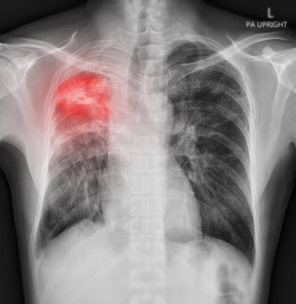 rtg klatki piersiowej ludzkiej klatki piersiowej lub płuc pokazujące płuca po wykryciu wirusa koronowego 2019. - x ray x ray image chest human lung zdjęcia i obrazy z banku zdjęć