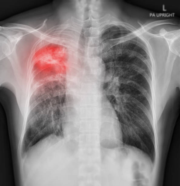 рентген грудной клетки человека грудной клетки или легких, показывающий легкие после обнаружения коронавируса 2019 года. - x ray x ray image chest human lung стоковые фото и изображения