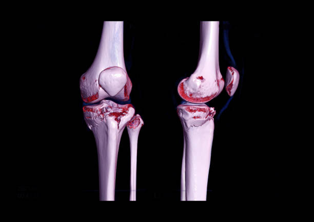 istock Compare AP and lateral view of CT knee joint 3D rendering image  showing fracture tibia bone. 1349428633